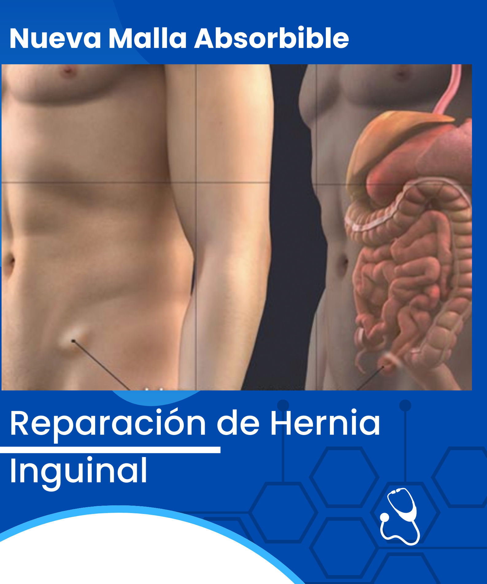 cirugia hernia inguinal